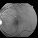 Choroidal Hemangioma Choroidal Hemangioma