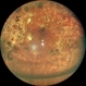 SILICONE OIL FILLED VITRECTOMISED EYE IN A CASE OF TRACTIONAL RETINAL DETACHMENT SILICONE OIL FILLED VITRECTOMISED EYE IN A CASE OF TRACTIONAL RETINAL DETACHMENT