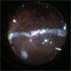 Inferior Retinectomy