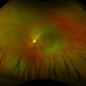Rod cone dystrophy Rod cone dystrophy