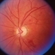Radiation Retinopathy Radiation Retinopathy