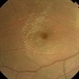 Neuroretinitis