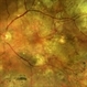Branching vascular network..Polypoidal choroidal vasculopathy Branching vascular network..Polypoidal choroidal vasculopathy