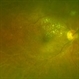 IRVAN Syndrome