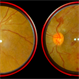Branch Retinal Vein Occlusion