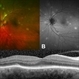 Early Findings in Cryptococcal Choroiditis Early Findings in Cryptococcal Choroiditis