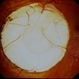 Disc Coloboma