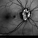 Drusen of Optic Disc Drusen of Optic Disc