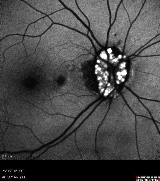degrees c 30 Optic Bank Image Drusen Retina of Disc degrees c 30 Optic Bank Image Drusen Retina of Disc