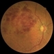 Superior Branch Retinal Vein Occlusion (BRVO) Superior Branch Retinal Vein Occlusion (BRVO)