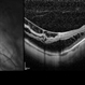 OCT Myopic Staphyloma With Schisis and ERM OCT Myopic Staphyloma With Schisis and ERM