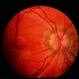 Pseudotumor Cerebri Pseudotumor Cerebri