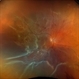 Retinal Detachment (Mac-Off) Retinal Detachment (Mac-Off)