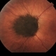 Melanocytoma of Optic Disc Melanocytoma of Optic Disc