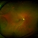 Retinoschisis Right Eye Retinoschisis Right Eye