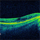 Optic Nerve Pit Related Serous Retinal Detachment