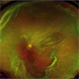 Giant Tear and Vitreous Abnormalities in Stickler Syndrome