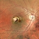 Toxoplasmosis Scar Toxoplasmosis Scar