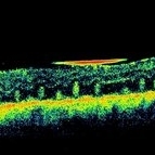 Retinal Folds Following Retinal Reattachment Surgery - Retina Image Bank