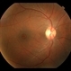Tamoxifen Retinopathy  with a Large atrophic, near full-thickness macular hole OD (Pseudocystic Foveal Cavitation)