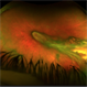 Familial Exudative Vitreoretinopathy (FEVR)