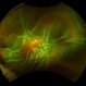 Retinal Detachment and Inferonasal Dialysis
