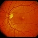 Adult Foveomacular Dystrophy / Pattern Adult Foveomacular Dystrophy / Pattern