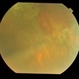 Traumatic Optic Neuropathy With Macular Scar