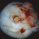 Posterior View of Enucleated Eye with Extraocular Extension of an Intraocular Tumor Posterior View of Enucleated Eye with Extraocular Extension of an Intraocular Tumor