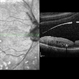 Macular Pseudohole