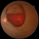 Premacular Retrohyaloid Hemorrhage