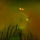 Acute Zonal Occult Outer Retinopathy (AZOOR)