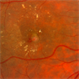 Retinal Angiomatous Proliferation Retinal Angiomatous Proliferation