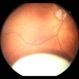 Traumatic Lens Dislocation Over Retina