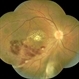 Inflammatory BRVO Inflammatory BRVO