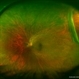 Giant Retinal Tear (GRT) Giant Retinal Tear (GRT)