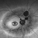 Pericentral Retinitis Pigmentosa Pericentral Retinitis Pigmentosa