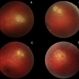 Toxoplasmic Chorioretinal Lesion Evolution Toxoplasmic Chorioretinal Lesion Evolution