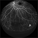 Retinal Cavernous Hemangioma