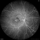 Congenital Retinal Macrovessel Congenital Retinal Macrovessel