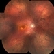 Cancer-Associated Retinopathy (CAR) Cancer-Associated Retinopathy (CAR)