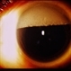 Inverted Hypopyon - Silicon Oil Complication Inverted Hypopyon - Silicon Oil Complication