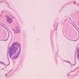 Retinoblastoma