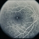 Macular Hole Evolving / Lamellar Hole Macular Hole Evolving / Lamellar Hole