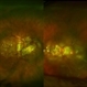 Macular Hole Retinal Detachment Over a Posterior Staphyloma Macular Hole Retinal Detachment Over a Posterior Staphyloma