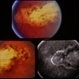 Myopia Myopia