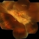 Proliferative Vitreoretinopathy Under Silicone Oil