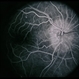 Congenital Disc Anomaly Congenital Disc Anomaly