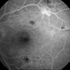 Neovascularization - RDP