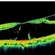 Bilateral Myopic Foveoschisis